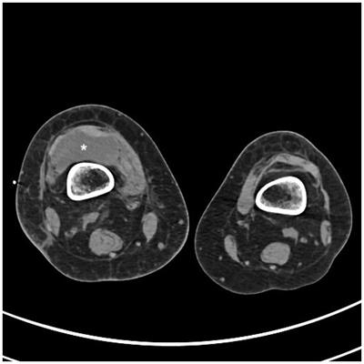 Staphylococcus lugdunensis: an unusual cause of relapsing hematogenous septic arthritis of a native knee. Case report and review of the literature